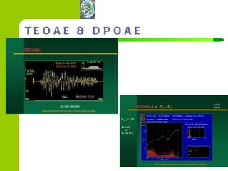 TEOAE & DPOAE 