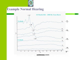 Example Normal Hearing 18 Month-Old – 2000 Hz Tone-Burst 70 dBnHL 10 dBnHL 