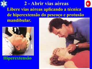 2 - Abrir vias aéreas
2 - Abrir vias aéreas
Libere vias aéreas aplicando a técnica
Libere vias aéreas aplicando a técnica
de hiperextensão do pescoço e protusão
de hiperextensão do pescoço e protusão
mandibular.
mandibular.
Hiperextensão
Hiperextensão
 