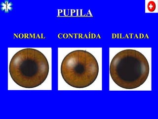 NORMAL CONTRAÍDA DILATADA
NORMAL CONTRAÍDA DILATADA
PUPILA
PUPILA
 