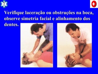 Verifique laceração ou obstruções na boca,
Verifique laceração ou obstruções na boca,
observe simetria facial e alinhamento dos
observe simetria facial e alinhamento dos
dentes.
dentes.
 
