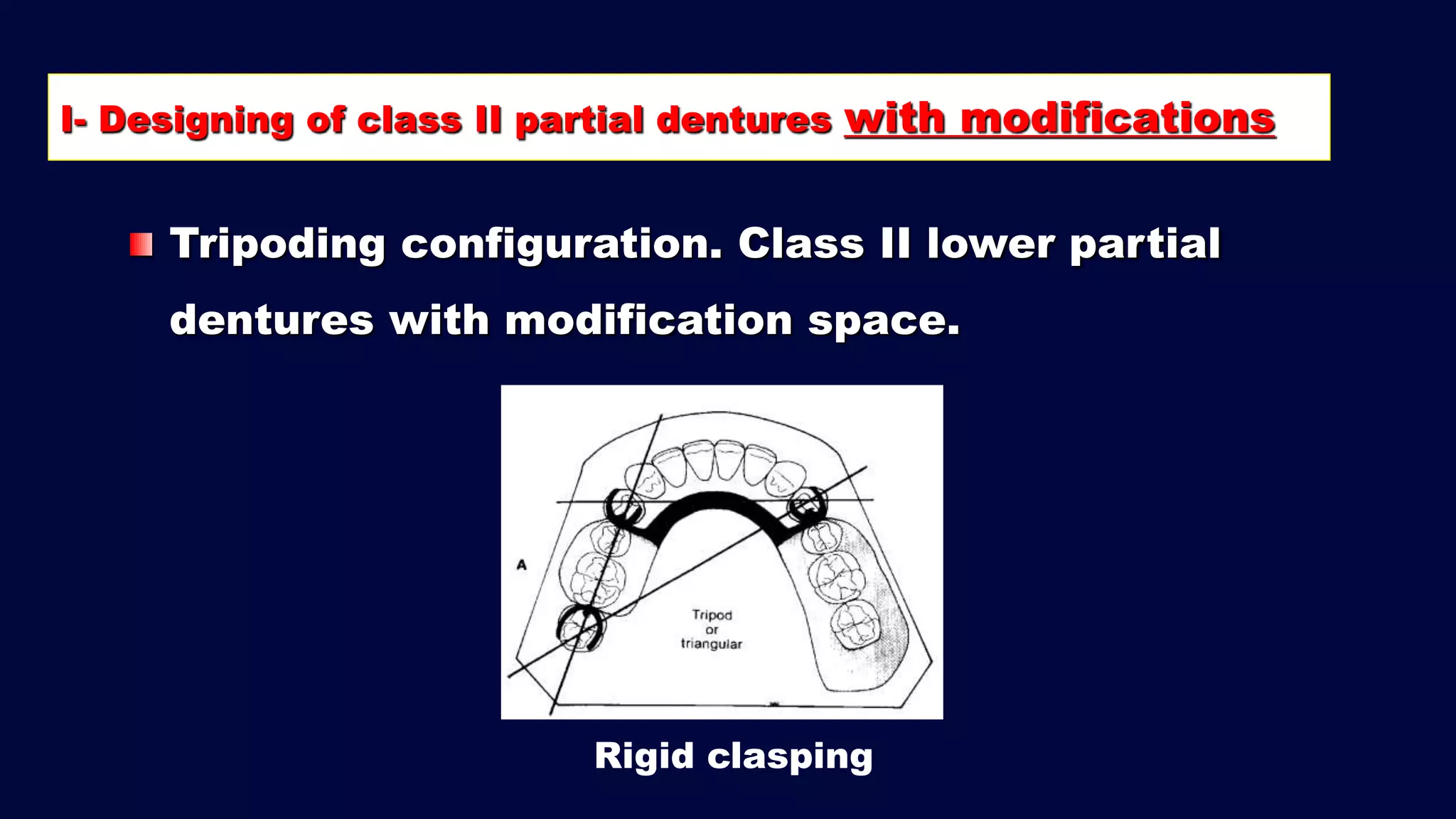 2- b. Basic principles for designing Kennedy class II, III and IV RPD ...