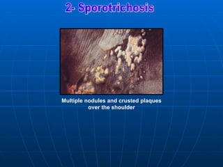 Multiple nodules and crusted plaques
          over the shoulder
 