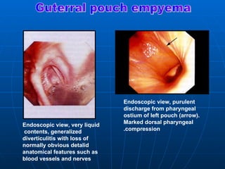 Endoscopic view, purulent
                               discharge from pharyngeal
                               ostium of left pouch )arrow(.
Endoscopic view, very liquid   Marked dorsal pharyngeal
 contents, generalized         .compression
diverticulitis with loss of
normally obvious detalid
anatomical features such as
blood vessels and nerves
 