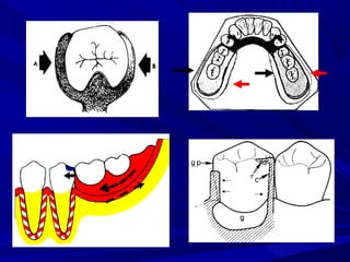 Denture Design Form 3- Basic principles for designing the removable partial denture | PPT