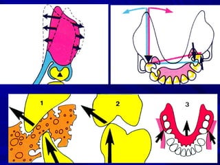 Denture Design Form 3- Basic principles for designing the removable partial denture | PPT