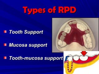 3- Basic principles for designing the removable partial denture | PPT
