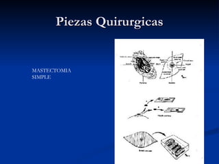 Piezas Quirurgicas MASTECTOMIA  SIMPLE 