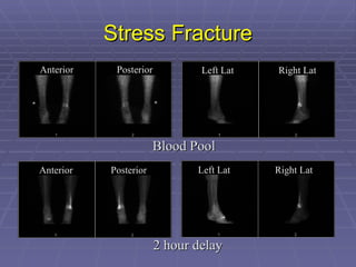 Stress Fracture Blood Pool Anterior Posterior Anterior Posterior Left Lat Right Lat Left Lat Right Lat 2 hour delay 