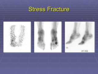 Stress Fracture 
