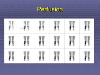 Perfusion 