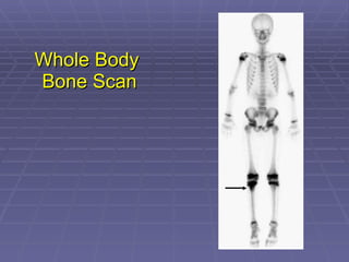 Whole Body  Bone Scan 