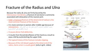 Fracture of the Radius and Ulna
Because the radius & ulna are firmly bound by the
interosseous membrane, a fracture of one bone is commonly
associated with dislocation of the nearest joint.
o Colle’ s Fracture (fracture of the distal end of radius) is the
most common fracture of the forearm.
o It is more common in women after middle age because of
osteoporosis. ‫الياس‬ ‫سن‬ ‫بعد‬ ‫االستروجين‬ ‫مستوى‬ ‫انخفاض‬ ‫بسبب‬
(
‫تم‬
‫الباثولوجي‬ ‫في‬ ‫بالتفصيل‬ ‫شرحه‬
)
o It causes dinner fork deformity.
o It results from forced dorsiflexion of the hand as a result to
ease a fall by outstretching the upper limb.
o The typical history of the fracture includes slipping.
o Because of the rich blood supply to the distal end of the
radius, bone union is usually good. (only in girls slides)
 