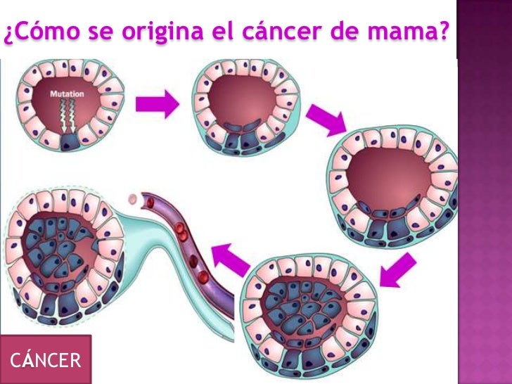 2. cancer mama listo