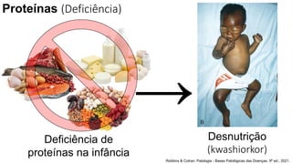 Deficiência de
proteínas na infância
Desnutrição
(kwashiorkor)
Proteínas (Deficiência)
→
Robbins & Cotran: Patologia - Bases Patológicas das Doenças. 9ª ed.; 2021.
 