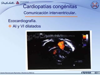 Cardiopatías congénitas
        Comunicación interventricular.

Ecocardiografía.
 AI y VI dilatados
 