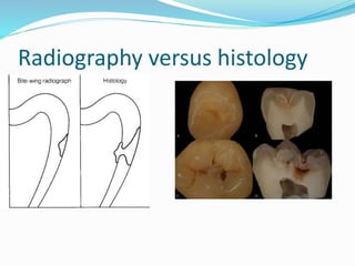 Radiography versus histology
 
