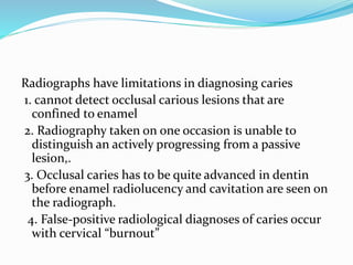 Radiographs have limitations in diagnosing caries
1. cannot detect occlusal carious lesions that are
confined to enamel
2. Radiography taken on one occasion is unable to
distinguish an actively progressing from a passive
lesion,.
3. Occlusal caries has to be quite advanced in dentin
before enamel radiolucency and cavitation are seen on
the radiograph.
4. False-positive radiological diagnoses of caries occur
with cervical “burnout”
 
