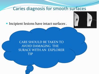 Caries diagnosis for smooth surfaces
 Incipient lesions have intact surfaces .
CARE SHOULD BE TAKEN TO
AVOID DAMAGING THE
SURACE WITH AN EXPLORER
TIP
 
