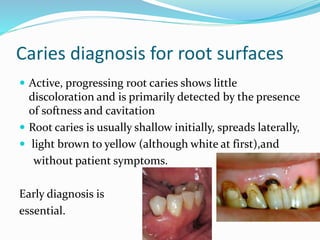 Caries diagnosis for root surfaces
 Active, progressing root caries shows little
discoloration and is primarily detected by the presence
of softness and cavitation
 Root caries is usually shallow initially, spreads laterally,
 light brown to yellow (although white at first),and
without patient symptoms.
Early diagnosis is
essential.
 