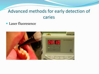 Advanced methods for early detection of
caries
 Laser fluoresence
 