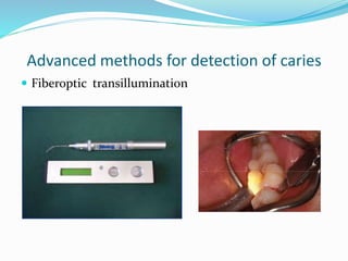 Advanced methods for detection of caries
 Fiberoptic transillumination
 