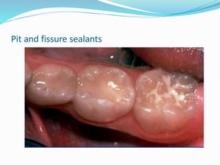 Pit and fissure sealants
 
