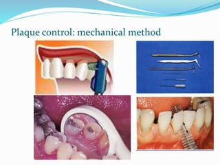 Plaque control: mechanical method
 