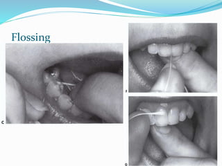 Flossing
 