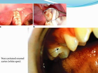 Non cavitated enamel
caries (white spot)
 