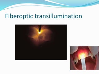 Fiberoptic transillumination
 