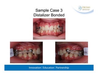 2 carriere distalizer | PDF