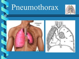 Pneumothorax
 