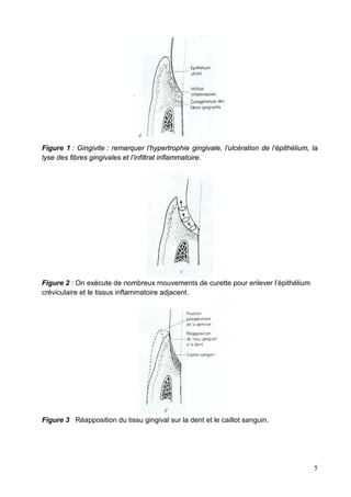 Figure 1 : Gingivite : remarquer l’hypertrophie gingivale, l’ulcération de l’épithélium, la
lyse des fibres gingivales et l’infiltrat inflammatoire.
Figure 2 : On exécute de nombreux mouvements de curette pour enlever l’épithélium
créviculaire et le tissus inflammatoire adjacent.
Figure 3 Réapposition du tissu gingival sur la dent et le caillot sanguin.
5
 