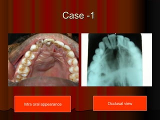CCaassee --11 
Intra oral appearance Occlusal view 
 