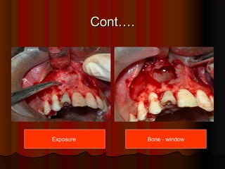 CCoonntt…….. 
Exposure Bone - window 
 