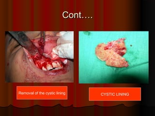 CCoonntt…….. 
Removal of the cystic lining CYSTIC LINING 
 