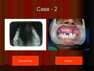 CCaassee -- 22 
Occlusal view Incision 
 
