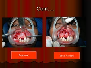CCoonntt…….. 
Exposure Bone -window 
 