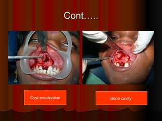 CCoonntt…….... 
Cyst enucleation Bone cavity 
 