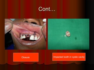 CCoonntt…… 
Closure Impacted tooth in cystic cavity 
 