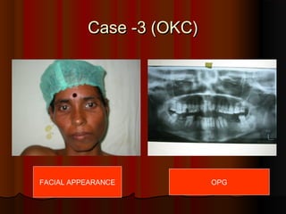 CCaassee --33 ((OOKKCC)) 
FACIAL APPEARANCE OPG 
 