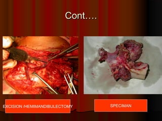 CCoonntt…….. 
EXCISION /HEMIMANDIBULECTOMY SPECIMAN 
 