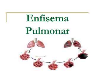 Enfisema
Pulmonar
 