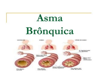 Asma
Brônquica
 