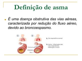 Definição de asma
■ É uma doença obstrutiva das vias aéreas,
caracterizada por redução do fluxo aéreo,
devido ao broncoespasmo.
 