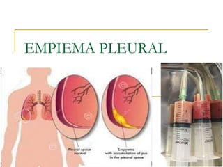 EMPIEMA PLEURAL
 