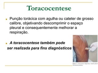Toracocentese
■ Punção torácica com agulha ou cateter de grosso
calibre, objetivando descomprimir o espaço
pleural e consequentemente melhorar a
respiração.
■ A toracocentese também pode
ser realizada para fins diagnósticos
 