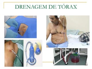 DRENAGEM DE TÓRAX
 