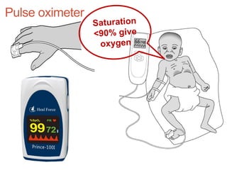 Pulse oximeter
Saturation
<90% give
oxygen
 